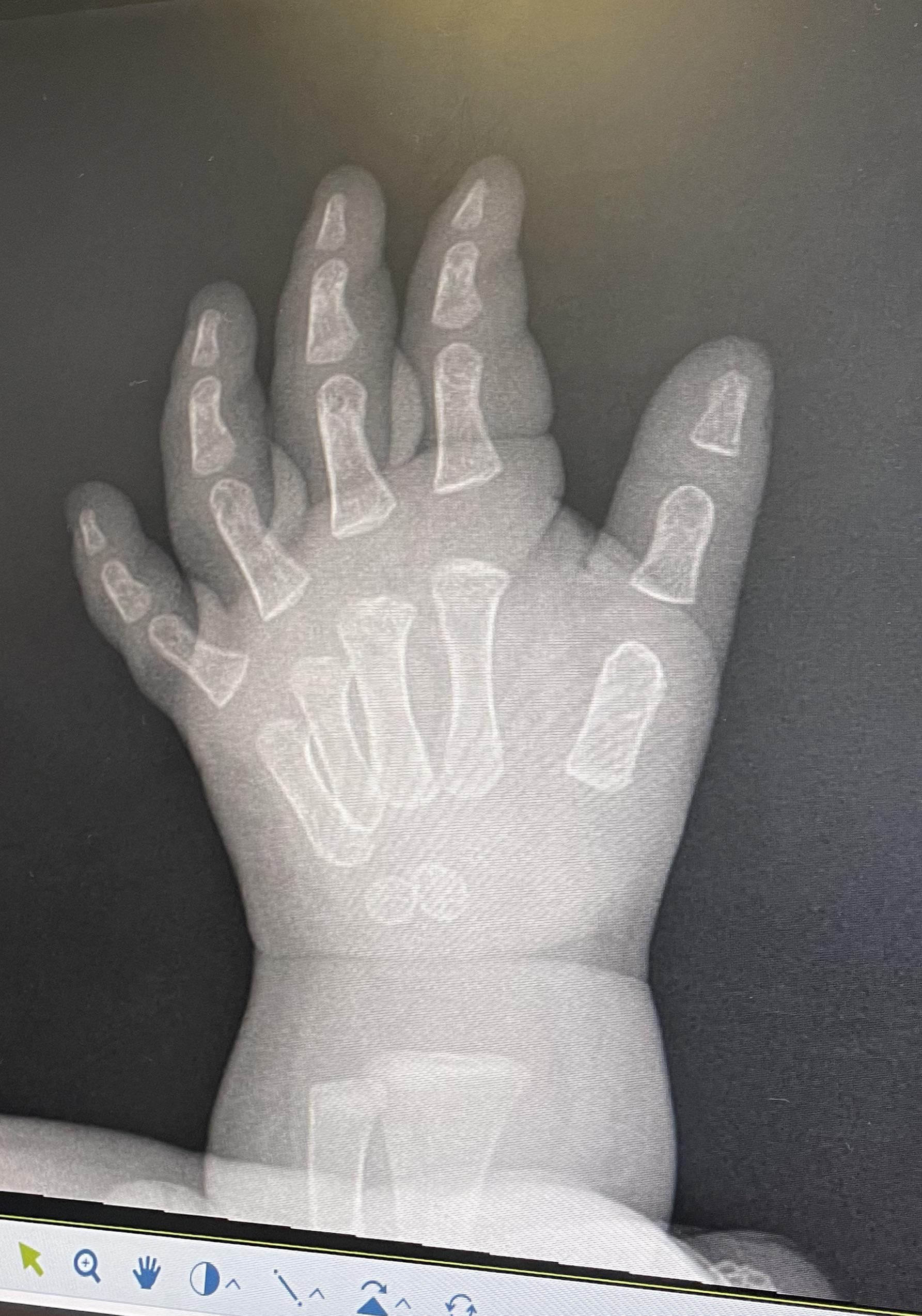 [from !parenting@lemmy.world] X-ray of a baby's hand make it look like their bones are floating around in there